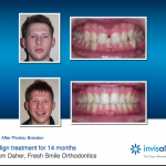 Invisalign for Teens AND Adults!